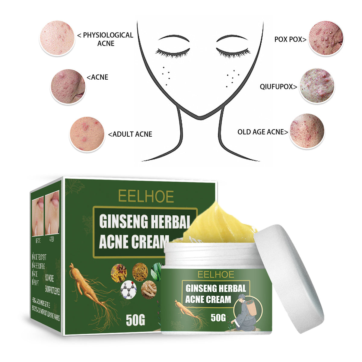 Herbal Acne-Removing Cream Anti-acne-Removing Cream Moisturizing Cleansing Cream Water Oil Balance Anti-acne-Removing Cream