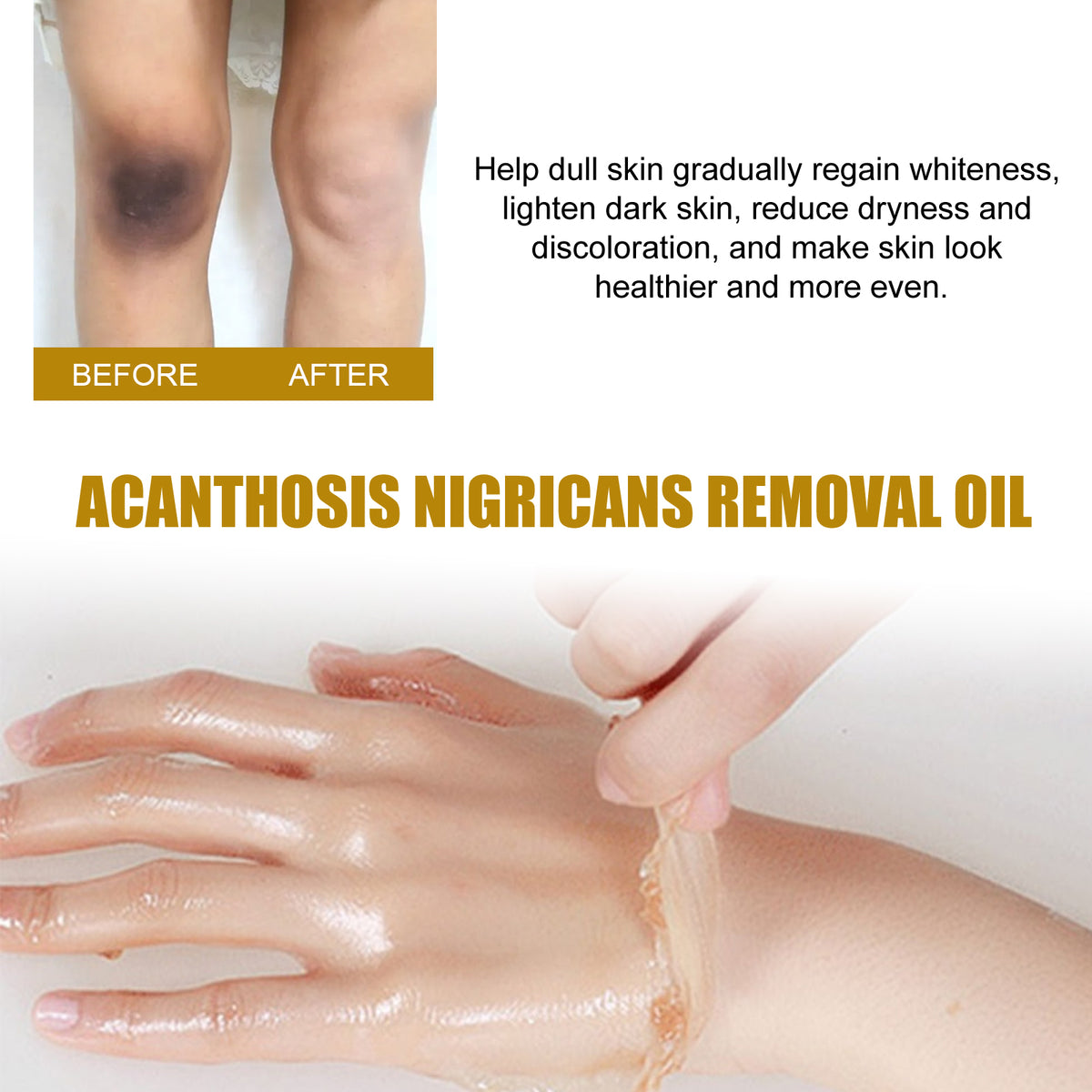 Acanthosis Nigricans Removal Oil, Exfoliating Light Black Brightening And Beauty Skin Oil