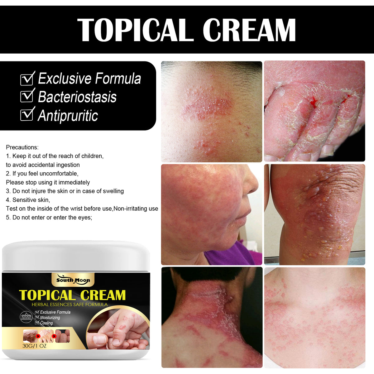 South Moon Anti-Itch Cream For Sweat Blister, Anti-Itch Cream For Dry, Itchy Skin, Anti-Itch Cream For Mosquito Bites And Repair Cream