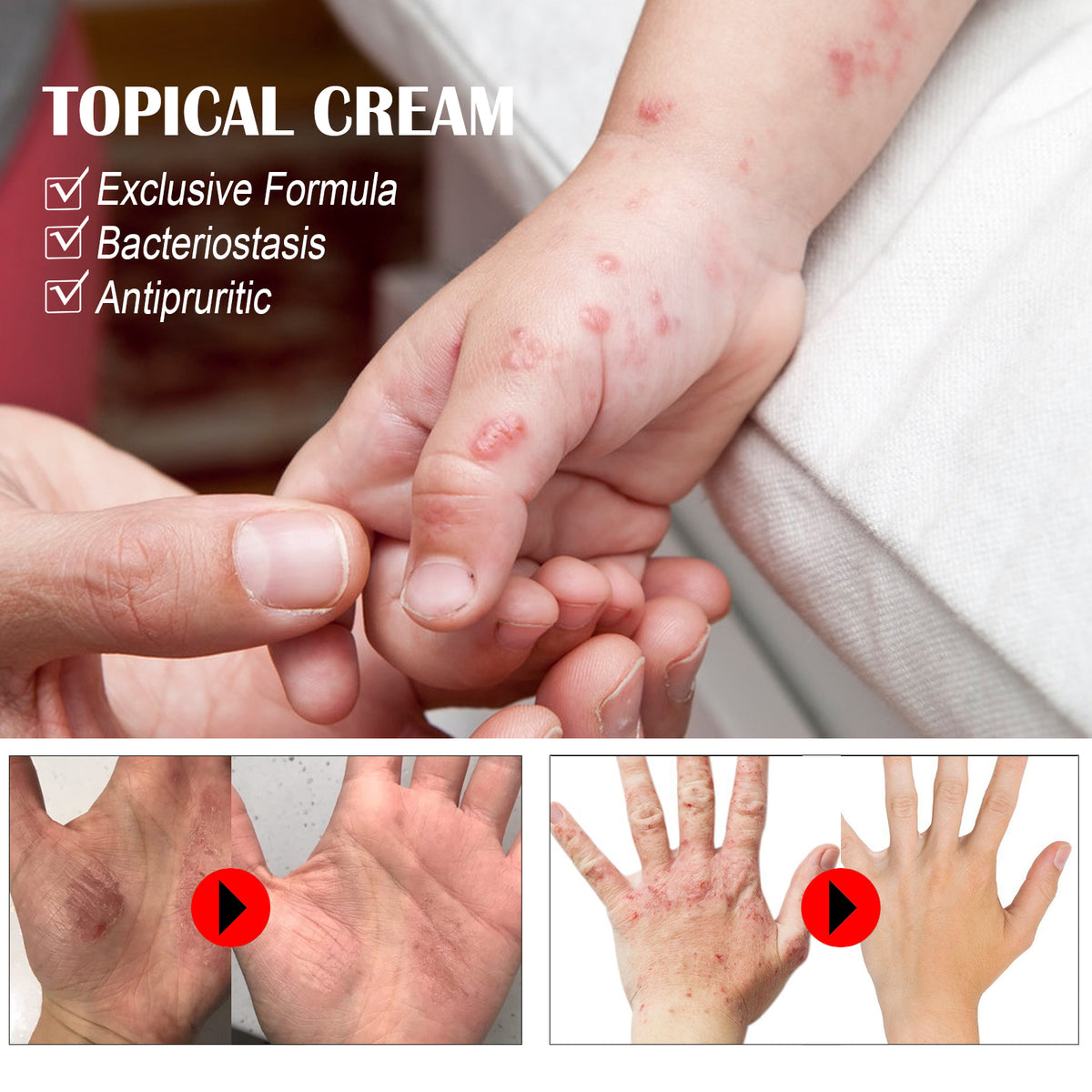 South Moon Anti-Itch Cream For Sweat Blister, Anti-Itch Cream For Dry, Itchy Skin, Anti-Itch Cream For Mosquito Bites And Repair Cream